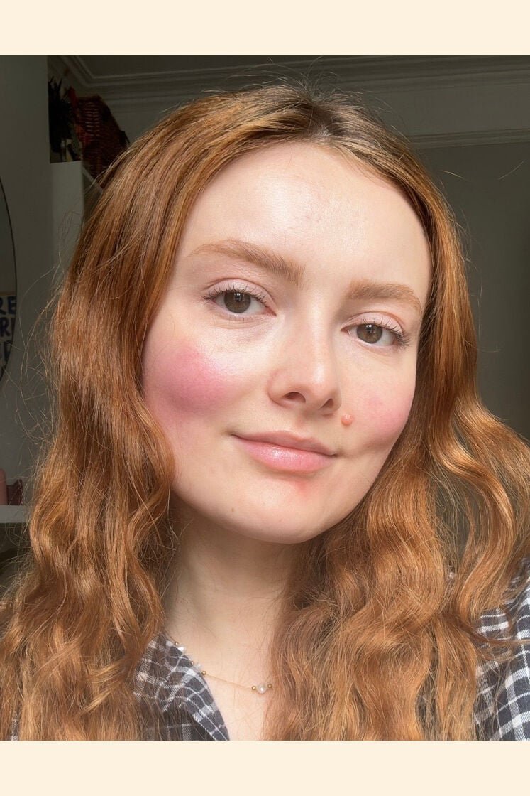 BBL laser rosacea results